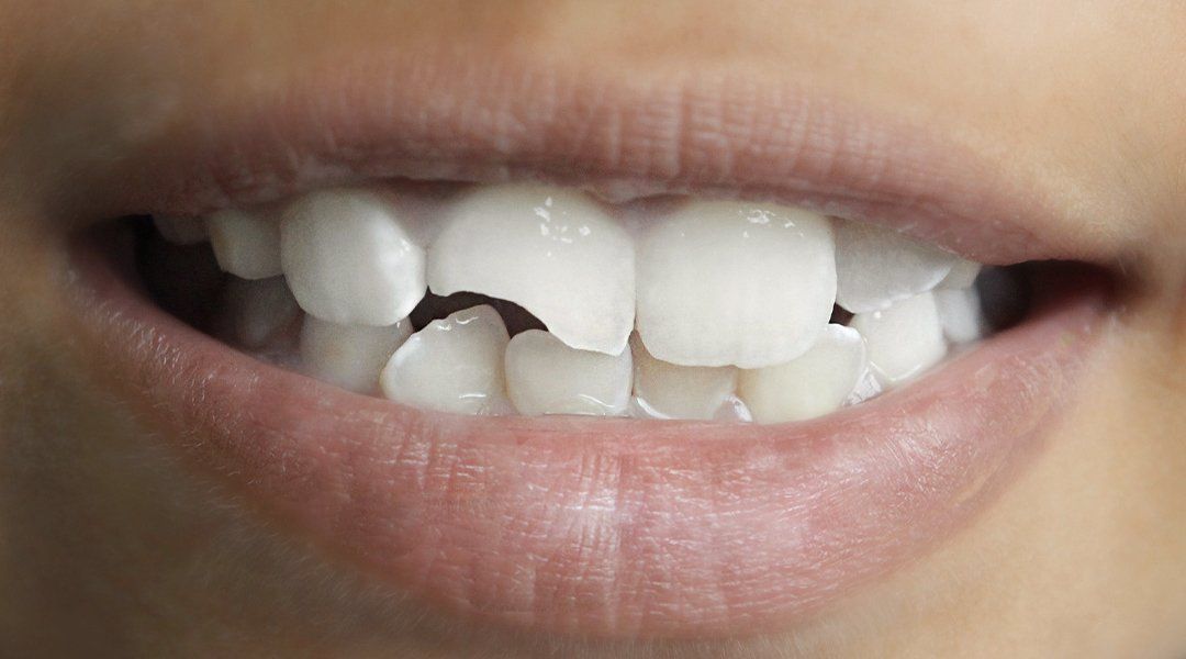 A chipped tooth and crooked smile of a woman